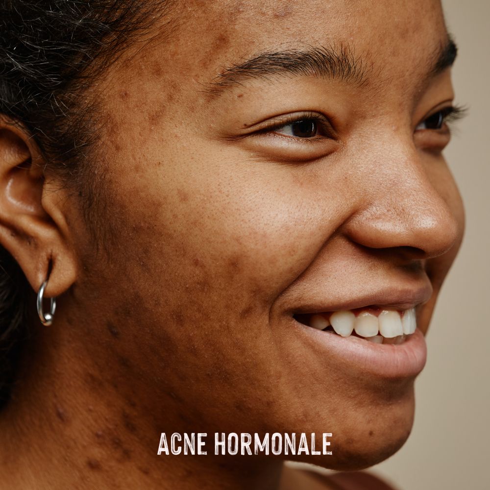 photo jeune femme avec acné hormonale princesse lia