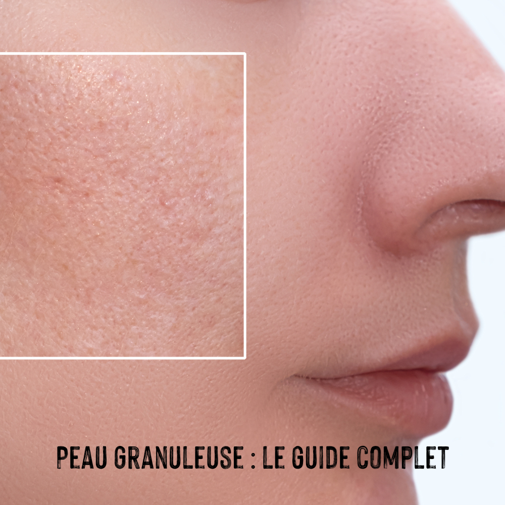 femme avec peau visage granuleuse