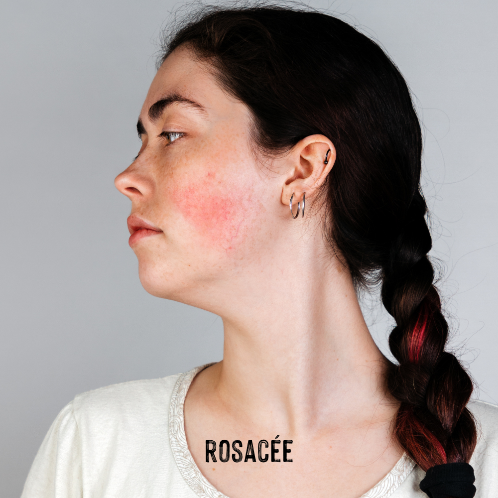 femme avec rosacée sur le visage