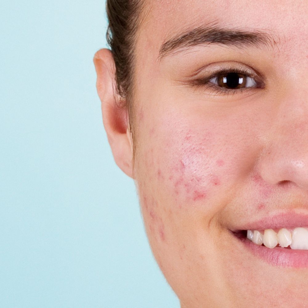 photo ado avec acné sur le visage