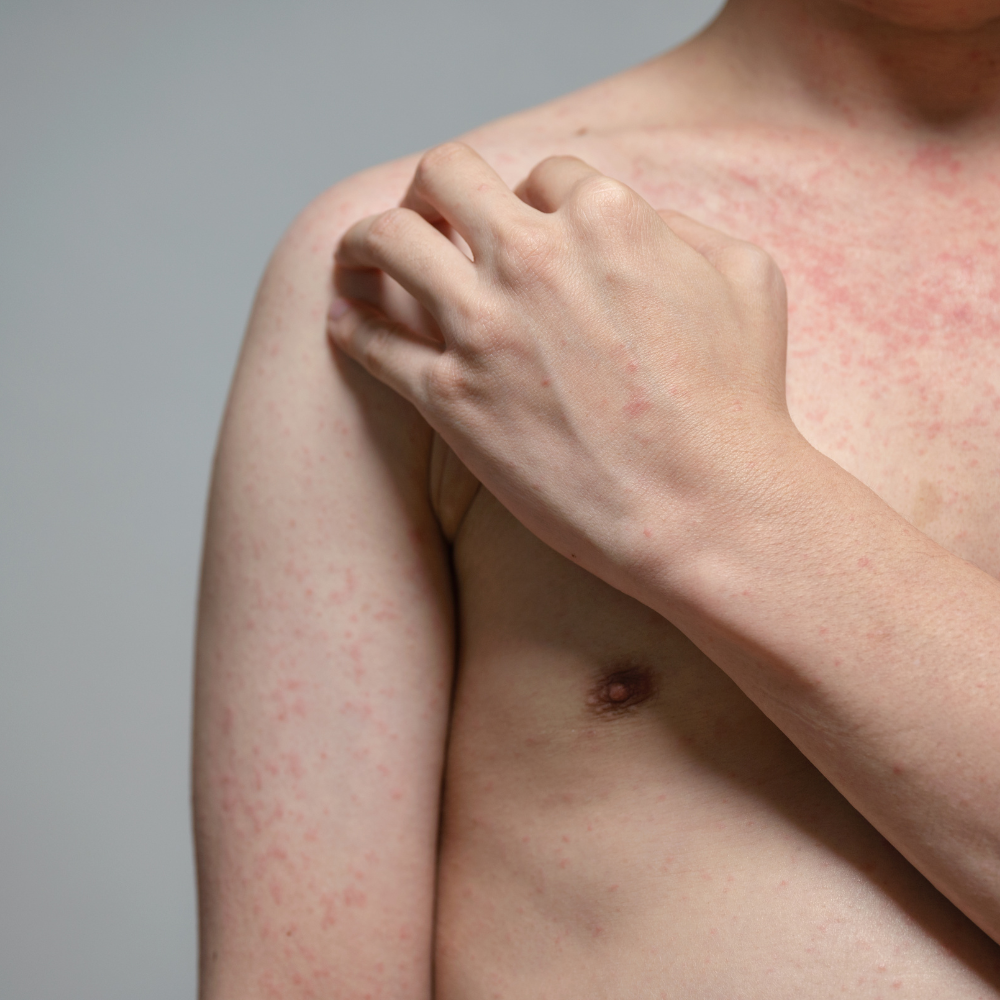 photo homme avec dermatite séborrhéique dans la barbe