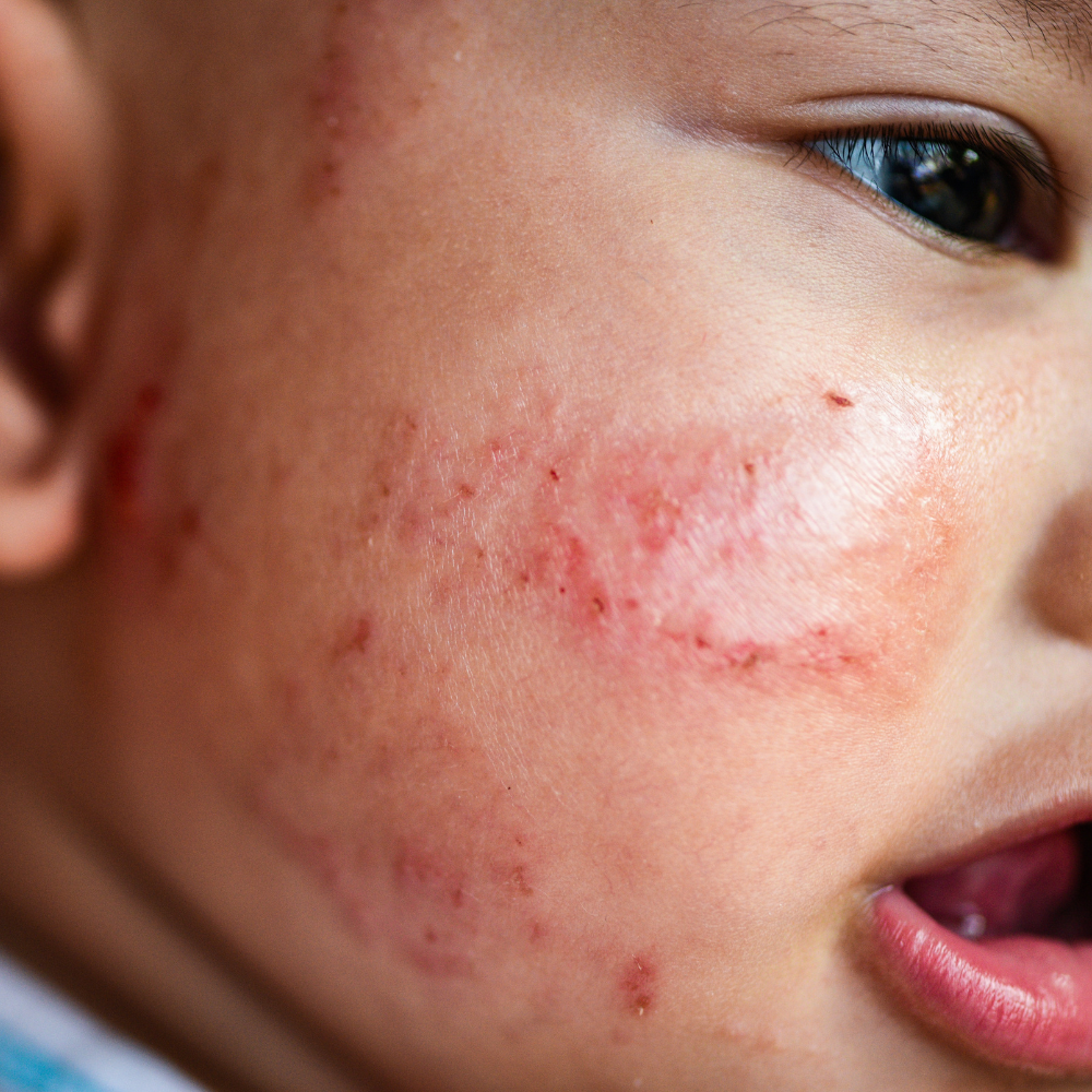 Eczéma Bébé : Causes, Prévention et Solutions Naturelles