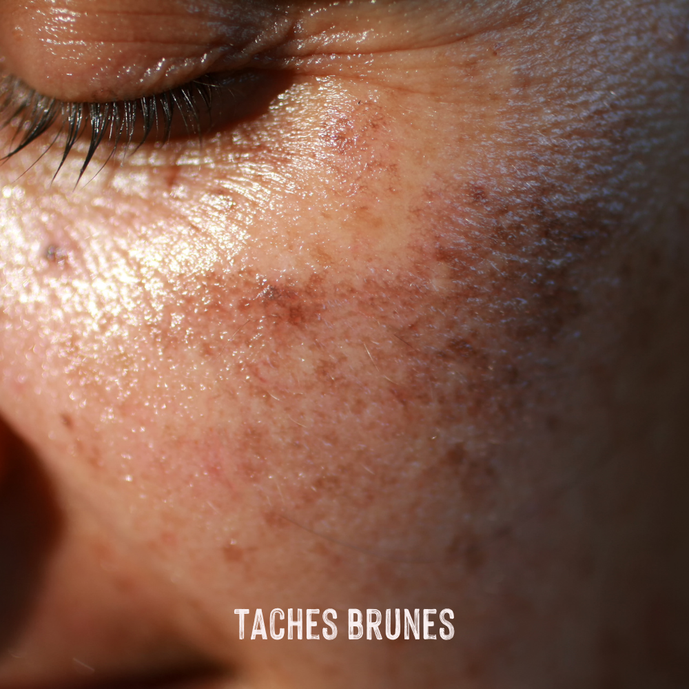 photo femme avec taches brunes sur le visage