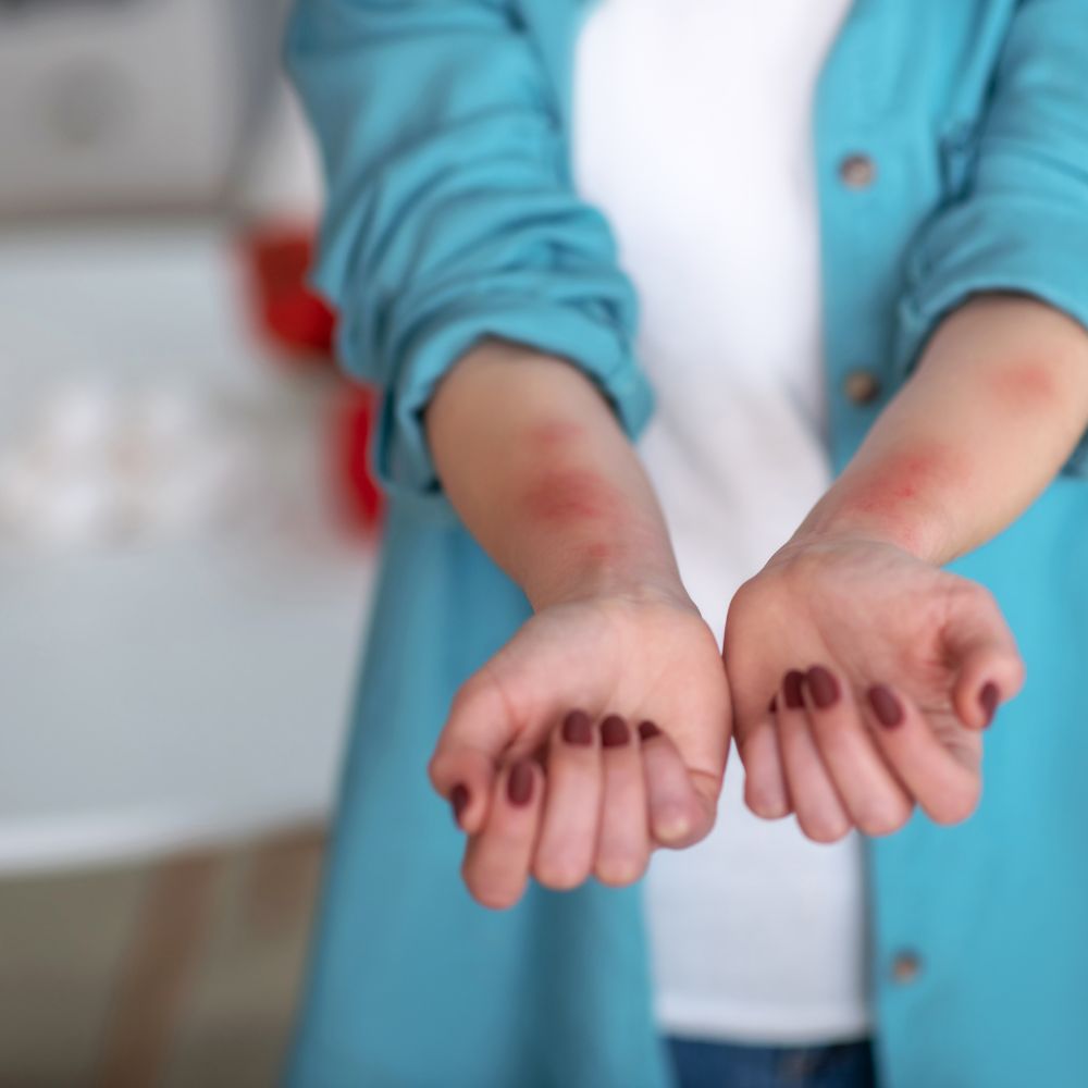 photo de bras avec urticaire