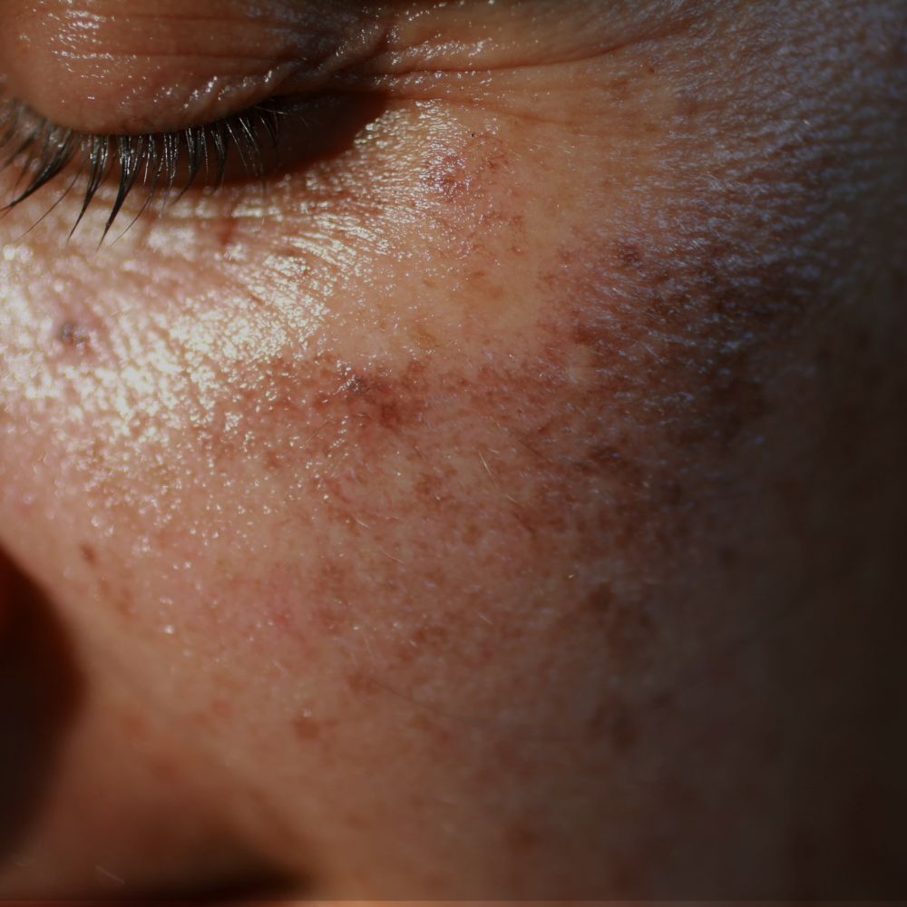 visage de femmes sans taches brunes sur le visage