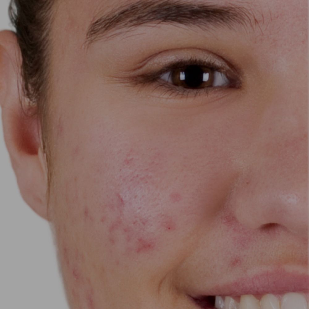 Routine soins naturels acné