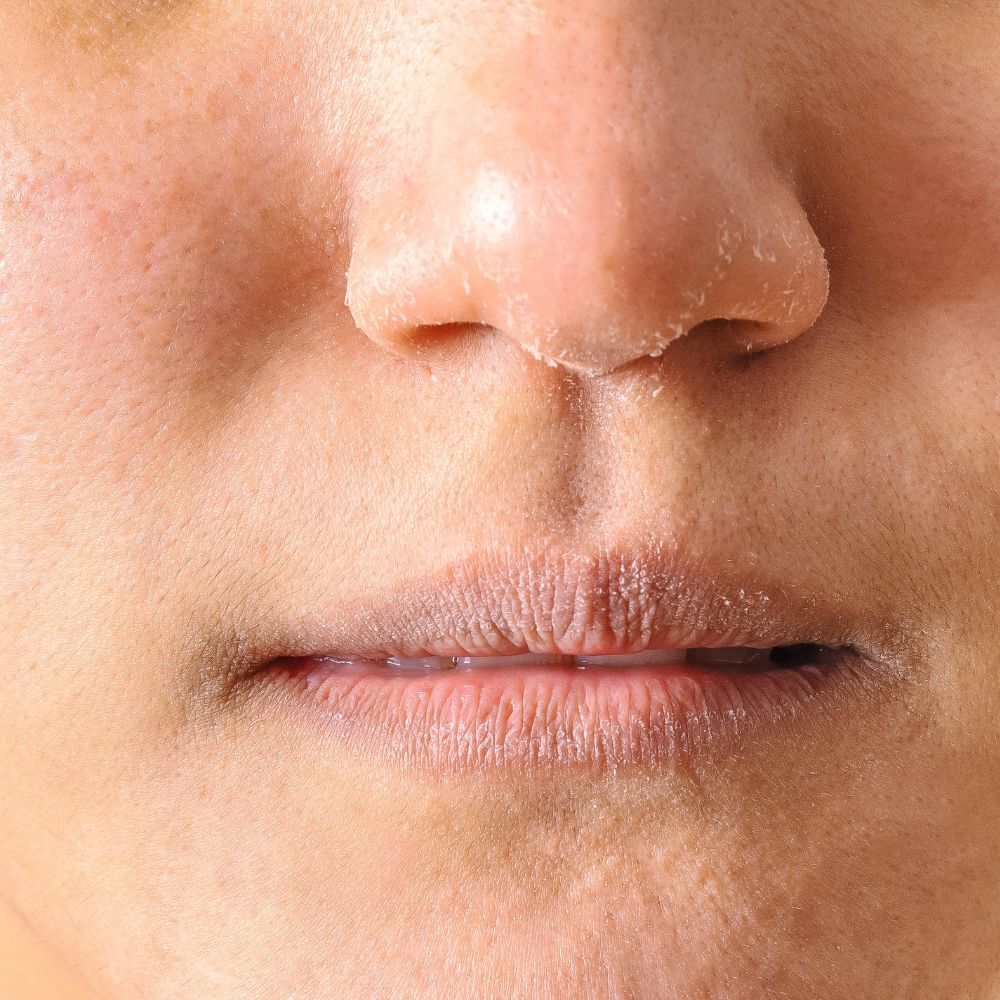photo visage avec eczéma